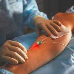 Laser varices