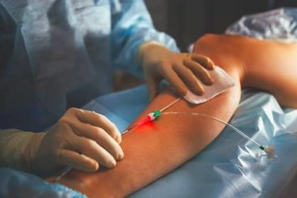 Laser varices